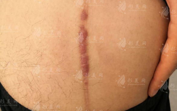 于艷菊治疤痕效果好嗎?專業(yè)解讀來(lái)了
