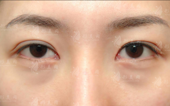鄭州健麗醫(yī)美不開刀祛眼袋，微創(chuàng)無痕告別眼袋煩惱