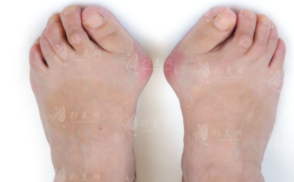 大腳骨微創(chuàng)手術(shù)哪家醫(yī)院好？全國拇外翻正規(guī)醫(yī)院排名前十公布