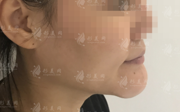 廣州漫一凡醫(yī)生取生長(zhǎng)因子靠譜嗎？4K內(nèi)窺鏡精準(zhǔn)取出技術(shù)解析