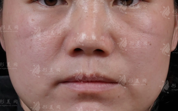 印第安紋怎么去除？分清類型選對醫(yī)美方案不花冤枉錢