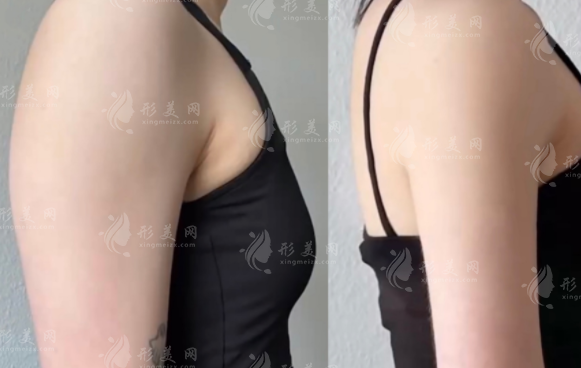 優(yōu)脂塑吸脂效果怎么樣？超聲乳化技術(shù)，出血少+恢復(fù)快+能雕馬甲線