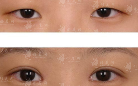 北京美萊上瞼下垂矯正好嗎?技術(shù)+價格全解析 北京美萊上瞼下垂矯正好嗎?技術(shù)+價格全解析