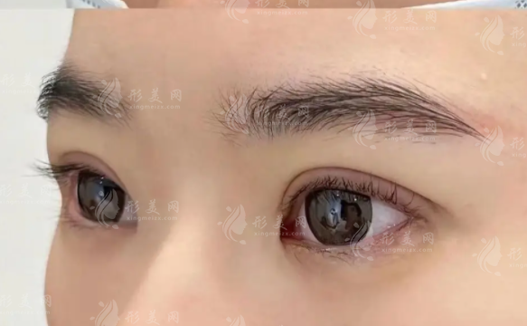 上海鄭小紅雙眼皮修復(fù)怎么樣?20年經(jīng)驗閉眼無痕技術(shù)價格8000起 上海鄭小紅雙眼皮修復(fù)怎么樣?20年經(jīng)驗閉眼無痕技術(shù)價格8000起