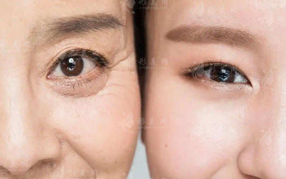 潤致5號玻尿酸會加速衰老?真相揭秘：大分子才是抗衰利器