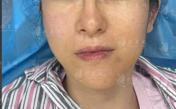 上海王洪醫(yī)生靠譜嗎?生長因子奧美定修復技術全揭秘 上海王洪醫(yī)生靠譜嗎?生長因子奧美定修復技術全揭秘