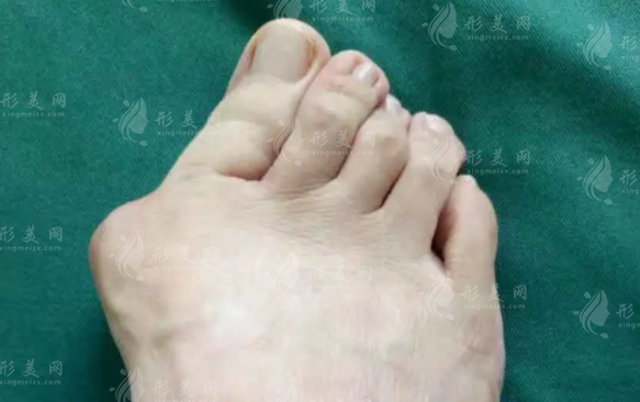 溫建民微創(chuàng)治大腳骨靠譜嗎？術(shù)后效果與費用詳解