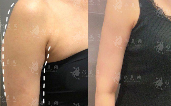 西安吸脂醫(yī)院哪家好？7家正規(guī)醫(yī)院技術(shù)實力盤點