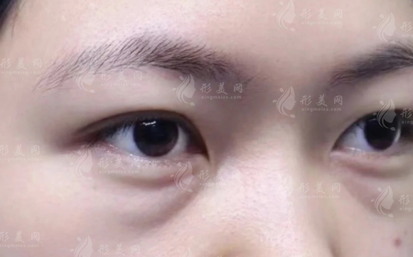 鄭州健麗不開(kāi)刀去眼袋靠譜嗎？技術(shù)價(jià)格人群全解析