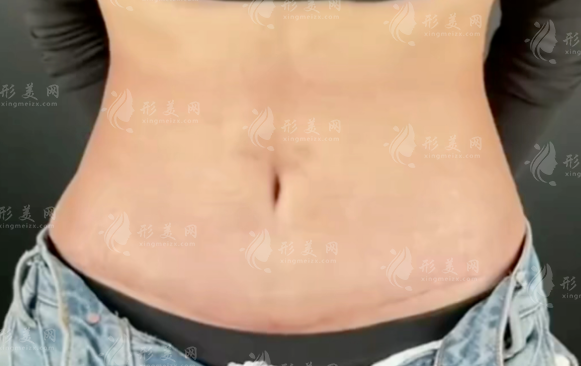成都腹壁整形選誰好?劉亞平vs李獻(xiàn)和技術(shù)口碑大比拼 成都腹壁整形選誰好?劉亞平vs李獻(xiàn)和技術(shù)口碑大比拼