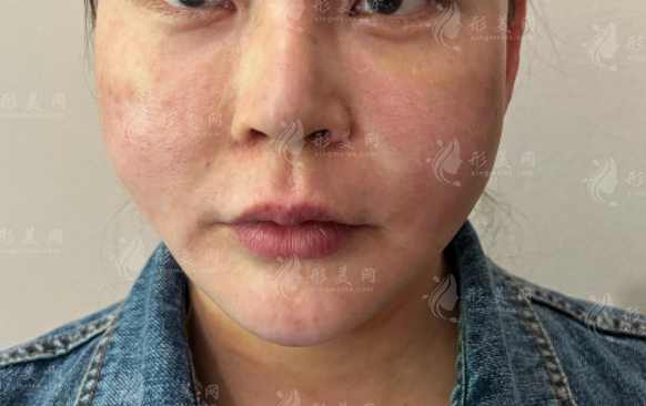 你是饅化臉還是幼態(tài)臉?5招自測+修復(fù)攻略一次說清