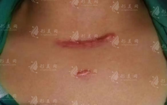 重慶祛疤醫(yī)院哪家好？軍科華美疤痕科口碑技術雙在線