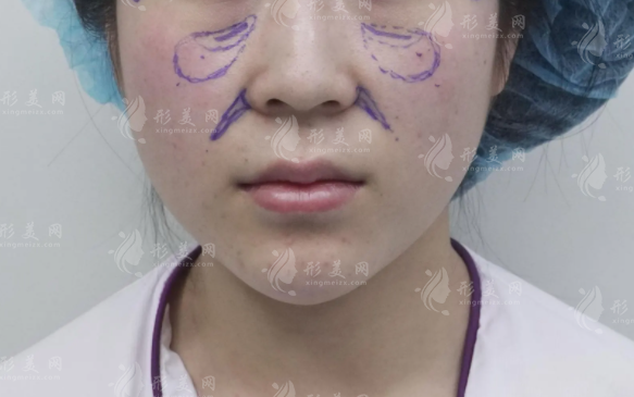 成都脂肪填充哪家好?怡脂整形局麻不住院自然變美攻略