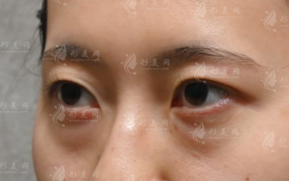 廣州曙光去眼袋6200元起，不開刀術(shù)式靠譜嗎?價格差異真相揭秘