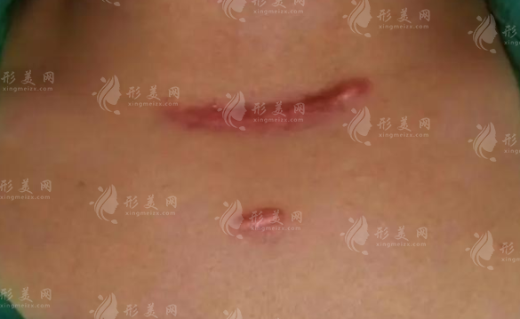 國內(nèi)疤痕修復(fù)醫(yī)院哪家好?10家正規(guī)祛疤機(jī)構(gòu)地址價格全攻略 