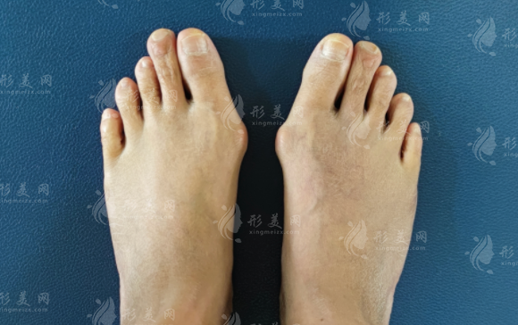 蘇敬達(dá)拇外翻VS傳統(tǒng)手術(shù):六大核心差異深度解析 蘇敬達(dá)拇外翻VS傳統(tǒng)手術(shù):六大核心差異深度解析