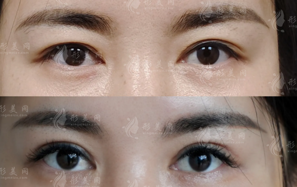 武漢眼修復(fù)醫(yī)生怎么選?王海平與項利姣技術(shù)對比+費用揭秘! 武漢眼修復(fù)醫(yī)生怎么選?王海平與項利姣技術(shù)對比+費用揭秘!