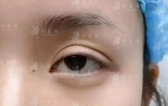 北京雙眼皮修復(fù)選師麗麗還是李燕?技術(shù)風(fēng)格對(duì)比+2026價(jià)格揭秘 北京雙眼皮修復(fù)選師麗麗還是李燕?技術(shù)風(fēng)格對(duì)比+2026價(jià)格揭秘
