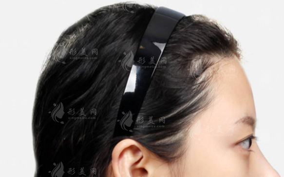 骨水泥顱頂填充術(shù)多少錢?手術(shù)全過程及價(jià)格表一覽