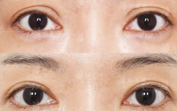 劉志剛雙眼皮修復(fù)怎么樣?假寬深眼修復(fù)技術(shù)解析 劉志剛雙眼皮修復(fù)怎么樣?假寬深眼修復(fù)技術(shù)解析