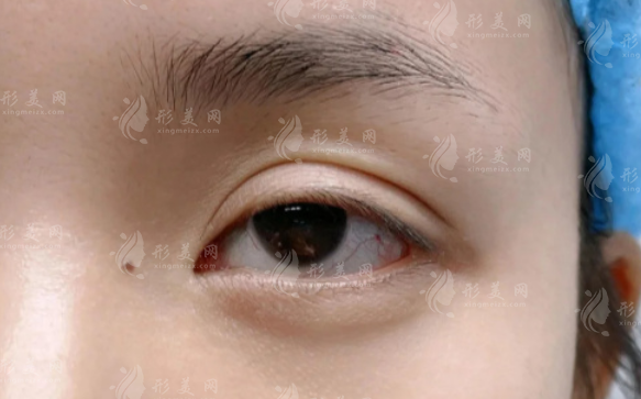 成都雙眼皮修復哪位醫(yī)生好?林靖/高亮/盧尚兵口碑實測 成都雙眼皮修復哪位醫(yī)生好?林靖/高亮/盧尚兵口碑實測