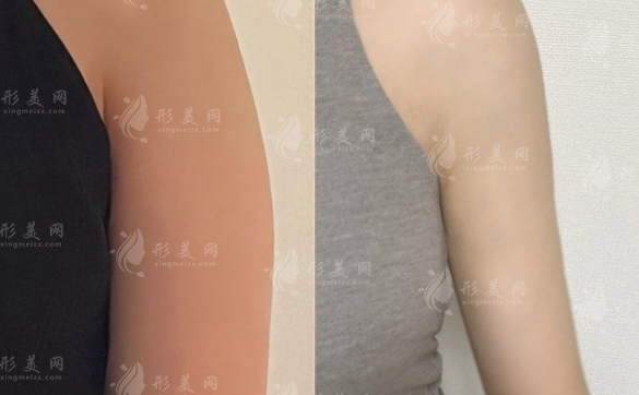 南京米嘉徐鶴然吸脂靠譜嗎?脂肪填充+威塑抽脂技術(shù)解析 南京米嘉徐鶴然吸脂靠譜嗎?脂肪填充+威塑抽脂技術(shù)解析