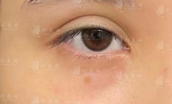 上海馬娟雙眼皮修復口碑揭秘：自然無痕技術獲認可