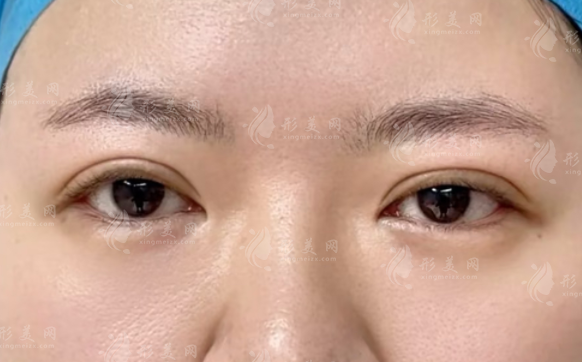 雙眼皮做寬了能改窄嗎?修復(fù)避坑指南+醫(yī)生推薦 雙眼皮做寬了能改窄嗎?修復(fù)避坑指南+醫(yī)生推薦