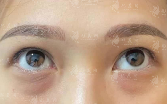淚溝填充選膠原蛋白還是玻尿酸?維持時(shí)間效果對比 淚溝填充選膠原蛋白還是玻尿酸?維持時(shí)間效果對比