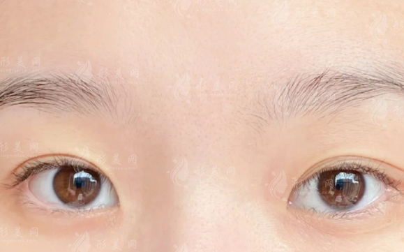 西安雙眼皮避坑指南:這10家正規(guī)醫(yī)院閉眼入不踩雷 西安雙眼皮避坑指南:這10家正規(guī)醫(yī)院閉眼入不踩雷