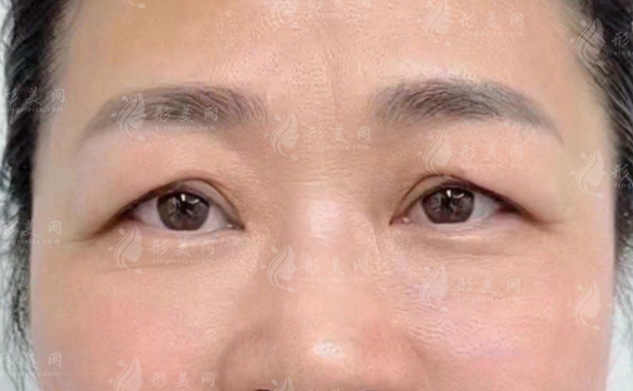 張冰潔眼修復靠譜嗎?20年經(jīng)驗+上萬案例深度解析 張冰潔眼修復靠譜嗎?20年經(jīng)驗+上萬案例深度解析