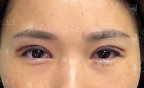 鄭州段珊珊雙眼皮靠譜嗎?楊麗嫡傳弟子技術(shù)揭秘 鄭州段珊珊雙眼皮靠譜嗎?楊麗嫡傳弟子技術(shù)揭秘