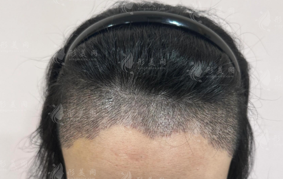 M型發(fā)際線拯救指南:山羊角禿額角3種修復方案對比 M型發(fā)際線拯救指南:山羊角禿額角3種修復方案對比