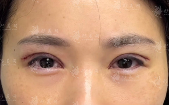北京張冰潔眼修復(fù)技術(shù)怎么樣?真實(shí)評價揭秘不踩坑 北京張冰潔眼修復(fù)技術(shù)怎么樣?真實(shí)評價揭秘不踩坑