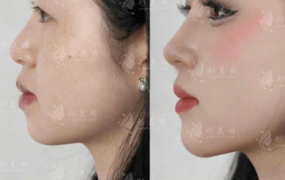 隆鼻后鼻子不舒服?教你分辨假體過敏與排異反應(yīng) 隆鼻后鼻子不舒服?教你分辨假體過敏與排異反應(yīng)