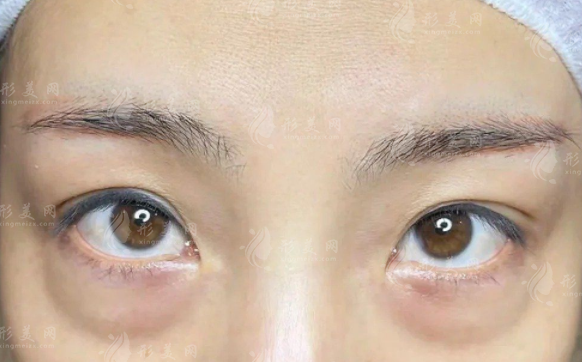 沈陽美萊祛眼袋怎么樣?醫(yī)生技術(shù)+價格表全揭秘 沈陽美萊祛眼袋怎么樣?醫(yī)生技術(shù)+價格表全揭秘