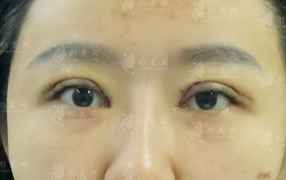 石家莊雙眼皮修復(fù)哪家好?靠譜醫(yī)院醫(yī)生排名推薦 石家莊雙眼皮修復(fù)哪家好?靠譜醫(yī)院醫(yī)生排名推薦