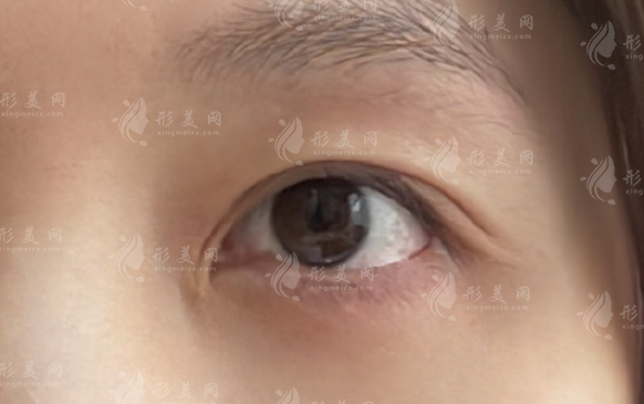 上海雙眼皮修復(fù)選誰好?張園園/許炎龍技術(shù)風(fēng)格深度解析 上海雙眼皮修復(fù)選誰好?張園園/許炎龍技術(shù)風(fēng)格深度解析