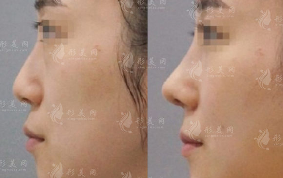 北京鼻修復(fù)醫(yī)生哪家好?徐永成/韓興斌/孫波等十大專家實(shí)力盤點(diǎn) 北京鼻修復(fù)醫(yī)生哪家好?徐永成/韓興斌/孫波等十大專家實(shí)力盤點(diǎn)