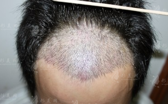 國內(nèi)連鎖植發(fā)醫(yī)院哪家好?十大正規(guī)機構(gòu)排名及春草植發(fā)地址價格 國內(nèi)連鎖植發(fā)醫(yī)院哪家好?十大正規(guī)機構(gòu)排名及春草植發(fā)地址價格