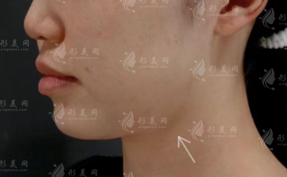 樸正國做下頜角怎么樣?長曲線截骨技術(shù)口碑價格全解析 樸正國做下頜角怎么樣?長曲線截骨技術(shù)口碑價格全解析
