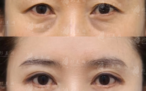 哈爾濱羽禪楊宇梓怎么樣?20年眼整形經(jīng)驗(yàn)技術(shù)口碑全解析 哈爾濱羽禪楊宇梓怎么樣?20年眼整形經(jīng)驗(yàn)技術(shù)口碑全解析