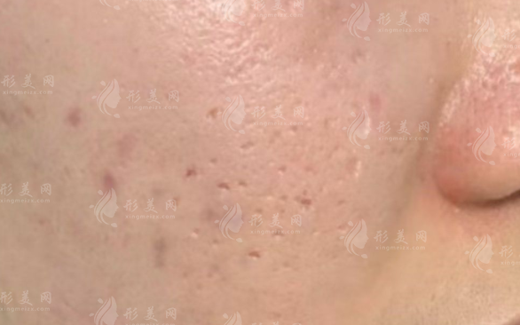 昆明點陣激光祛痘坑哪家好?這6家醫(yī)院口碑爆棚附價格表! 昆明點陣激光祛痘坑哪家好?這6家醫(yī)院口碑爆棚附價格表!