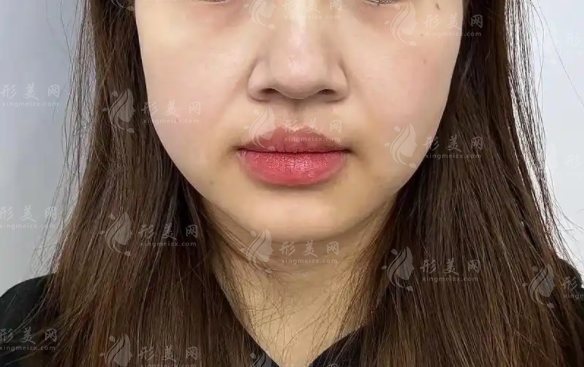 隋冰饅化臉修復效果好嗎?價格成效及醫(yī)生實力深度測評