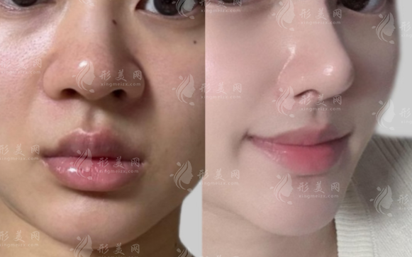 濡白天使vs瑞藍麗瑅隆鼻怎么選?成分/維持/價格全面對比
