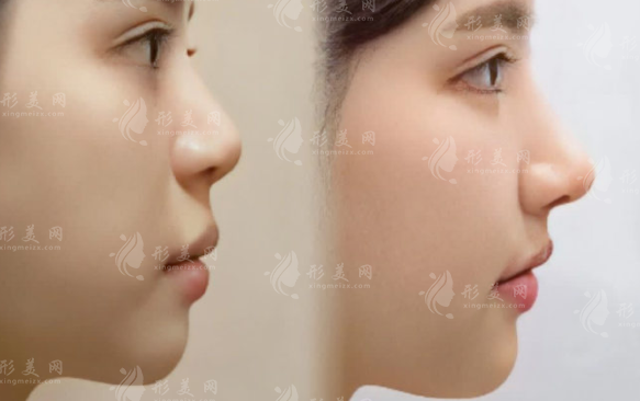 北京鼻修復(fù)醫(yī)生排名前十：技術(shù)口碑好的正規(guī)醫(yī)生推薦