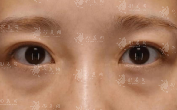 光能祛眼袋效果好嗎?和激光祛眼袋區(qū)別在哪?90%人分不清 光能祛眼袋效果好嗎?和激光祛眼袋區(qū)別在哪?90%人分不清