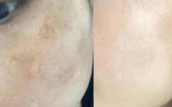 超皮秒除了祛斑還能干啥?5大隱藏功能全揭秘 超皮秒除了祛斑還能干啥?5大隱藏功能全揭秘