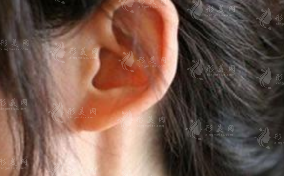 精靈耳、貼面耳、招風(fēng)耳怎么區(qū)分?一張圖看懂耳型特征