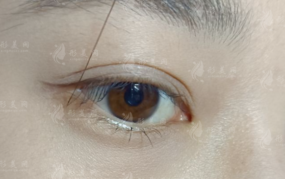 南京割雙眼皮哪家醫(yī)院好?口碑機構排名+實力醫(yī)生推薦